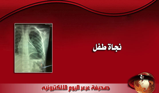 بالصور .. نجاة طفل من موت محقق بعد ابتلاعه قطعة حديدة ( مشبك شعر ) بعرعر