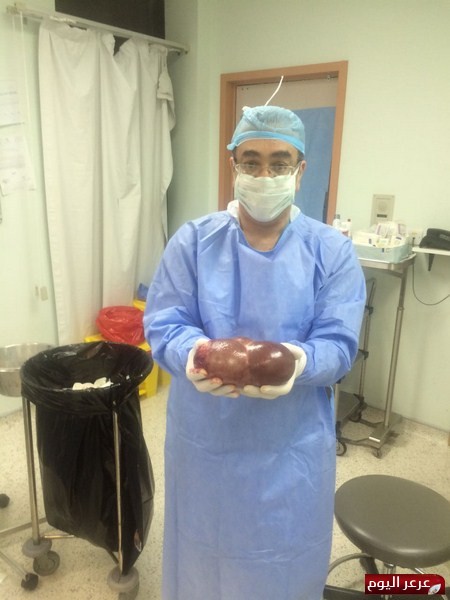 مستشفى رفحاء المركزي ينجح بأستئصال ورم من رحم أمرأة