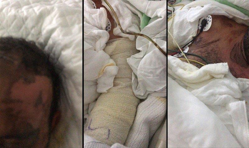 زوجة تسكب الأسيد الحارق على وجه وجسد زوجها بعد خلافه معها