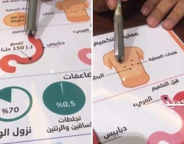 طبيب سعودي يشرح طريقة