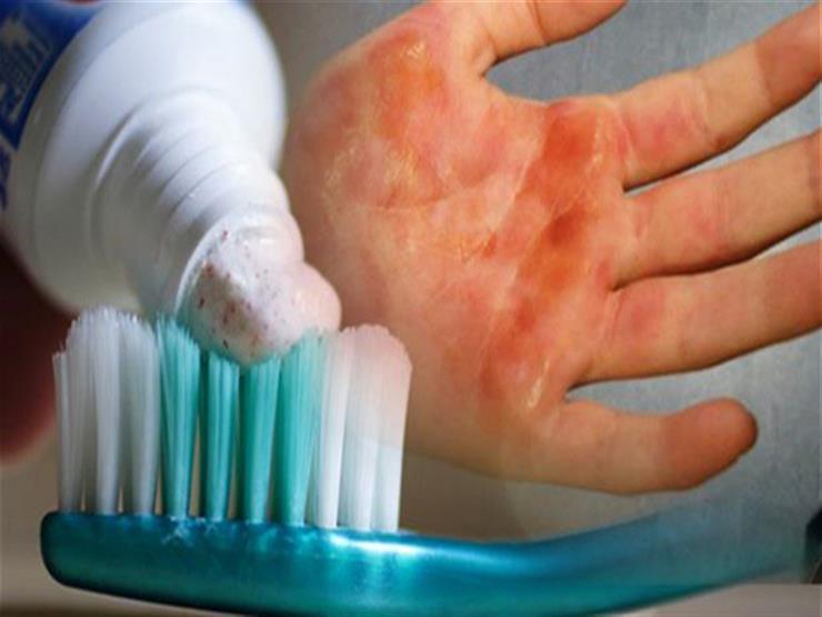 هل يمكن استخدام معجون الأسنان في علاج الحروق؟ ..